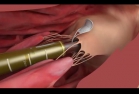 Implantation d’une valve mitrale par cathéter à l'IUCPQ. Gracieuseté de Edwards Lifesciences.